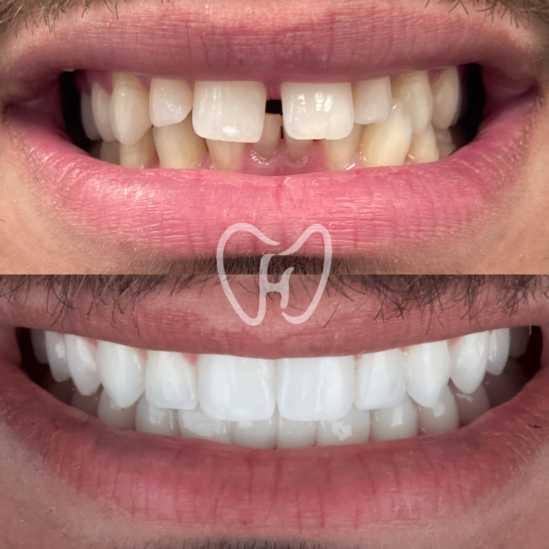 tandreglering treatment example3