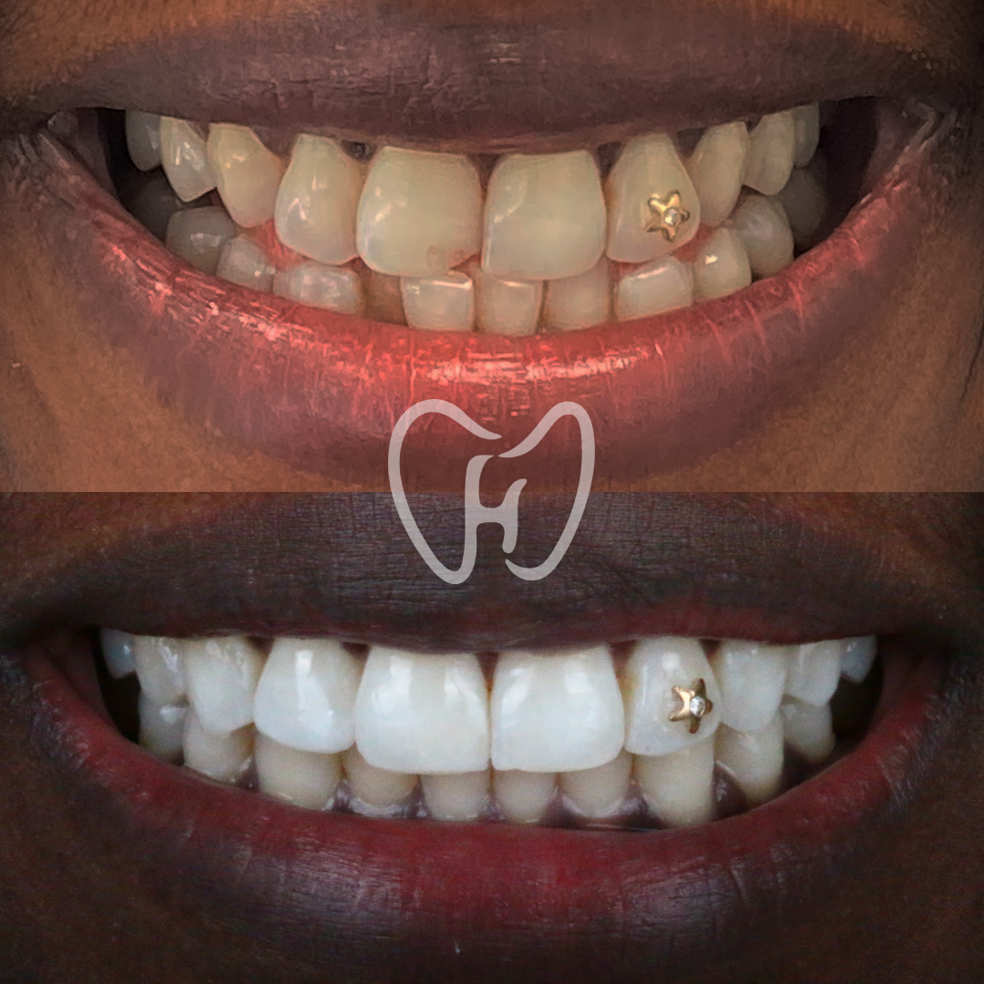 Tandreglering treatment example3