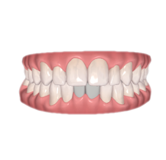 tandreglering treatment example2