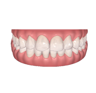 Tandreglering treatment example2